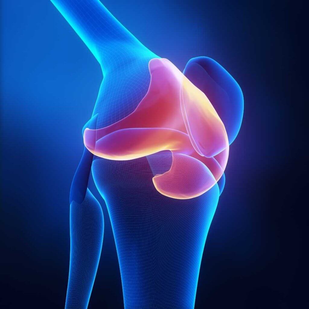 Ein Knorpelschaden im Knie kann die Funktion des Kniegelenks behindern, wenn das Knorpelgewebe das Reiben der Knochen nicht mehr verhindert.