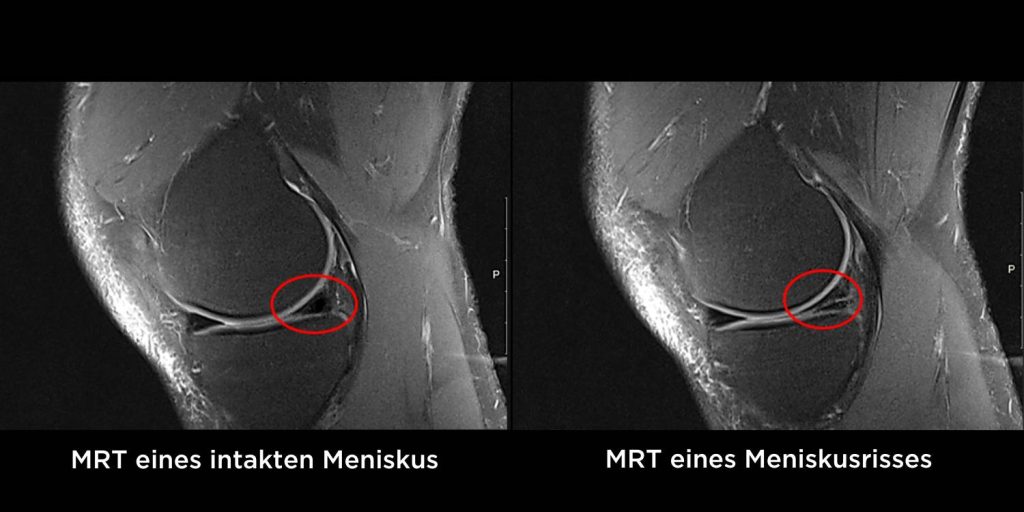 Zwei MRT Aufnahmen verdeutlichen, wo im Knie ein Meniskusriss passiert. Links das gesunde Knie mit intaktem Meniskus, rechts der Meniskusriss.
