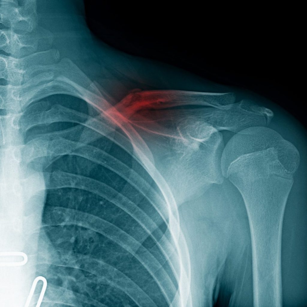 Ein Schlüsselbeinbruch (Claviculafraktur) entsteht meist durch eine direkte Gewalteinwirkung auf das Schlüsselbein, zum Beispiel durch einen Sturz auf den ausgestreckten Arm oder einen heftigen Schlag auf die Schulter.