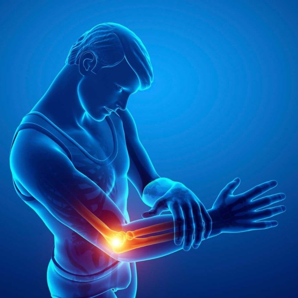 Freie Gelenkkörper sind Teile aus Knorpel-, Knochen- oder Muskelmaterial, die sich im Gelenk gelöst haben und zu Schmerzen und Bewegungseinschränkungen führen können.