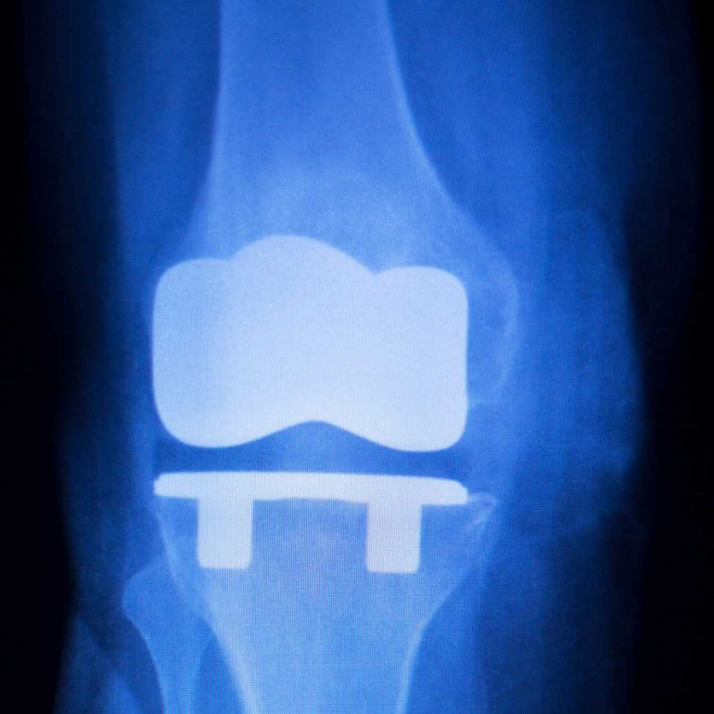 Ein künstliches Kniegelenk wird nötig, wenn ein irreparabler Gelenkverschleiß (z.B. aufgrund einer schweren Kniearthrose) vorliegt.