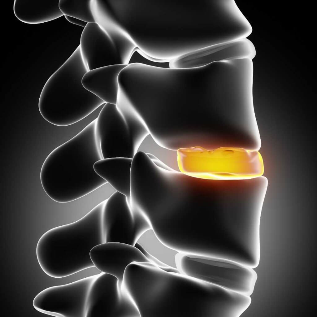 Osteochondrose intervertebralis ist die degenerative Veränderung der Bandscheibe, bei der es zu knöchernen Veränderungen im Bereich der Wirbelsäule kommt.