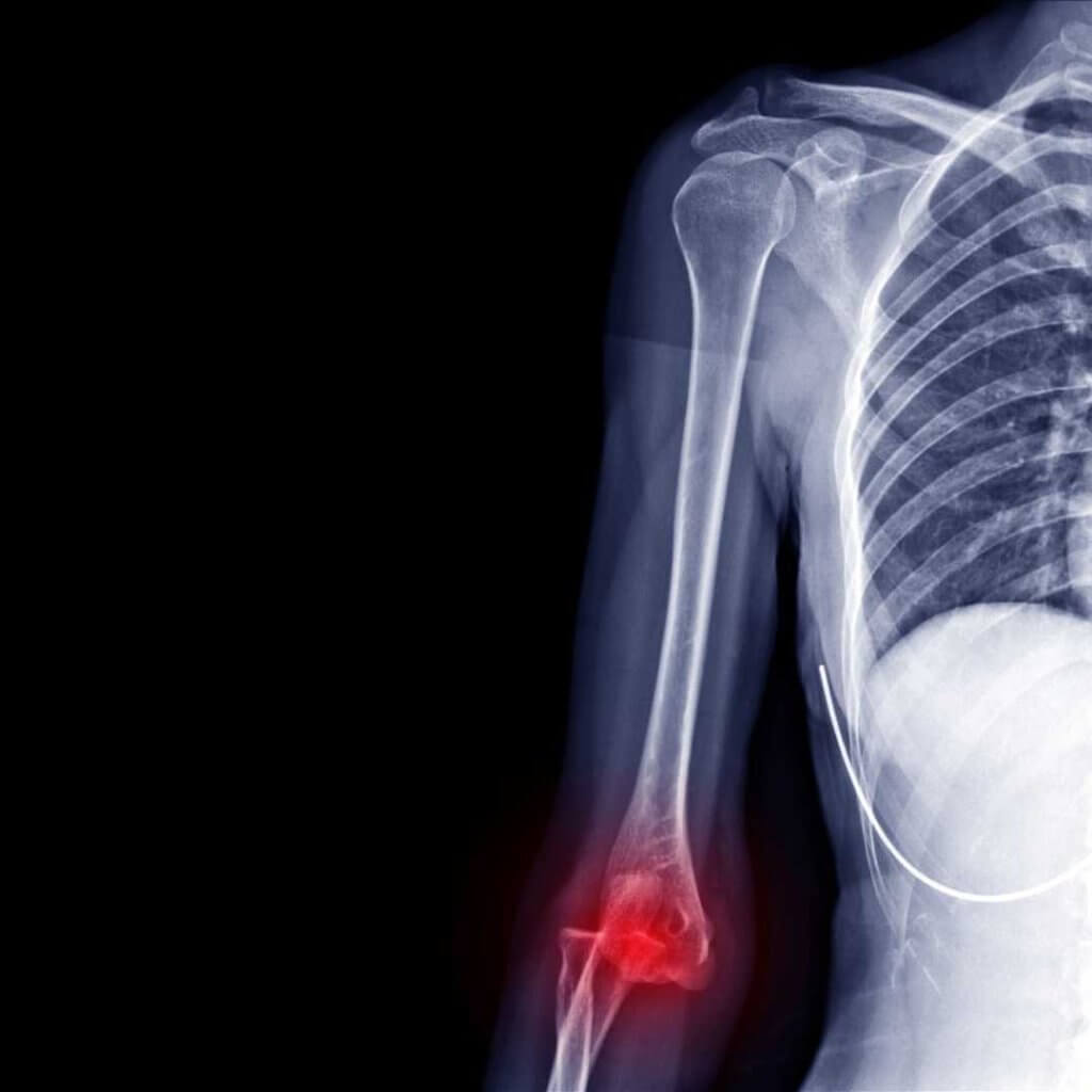 Viele Seitenbandverletzungen machen sich in der Regel sofort durch starke Schmerzen und Schwellungen bemerkbar.
